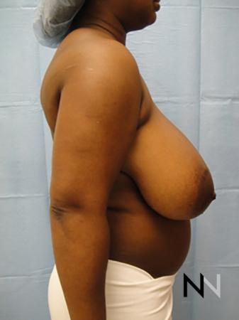 Breast Reduction: Patient 3 - Before and After Image 5