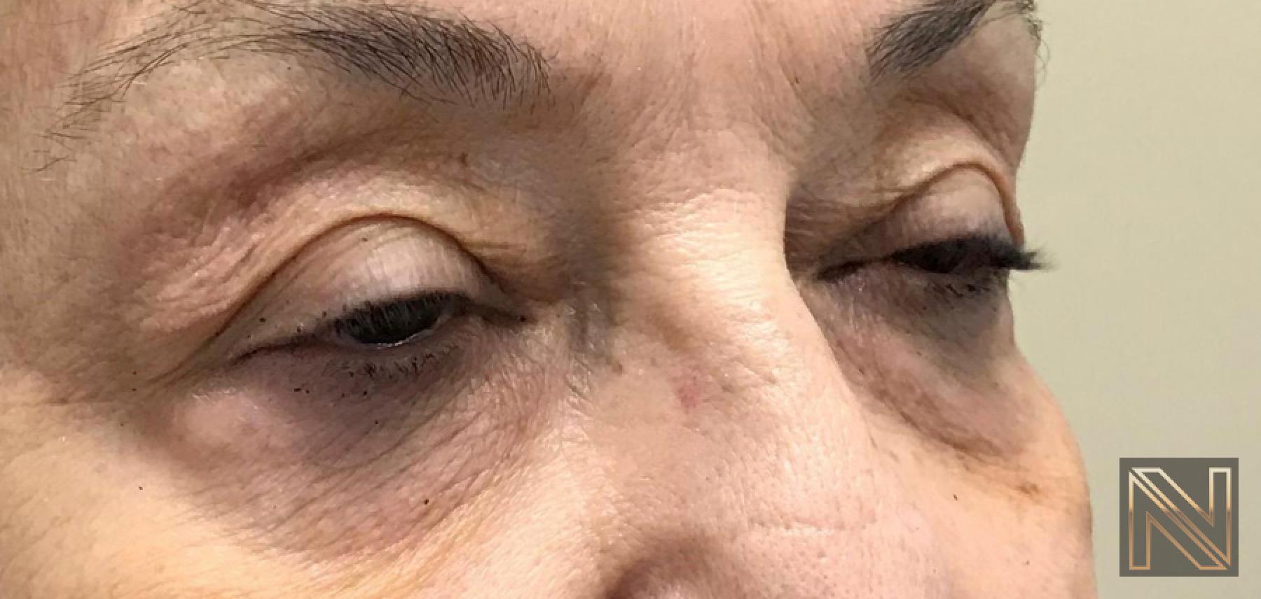 Fractional Resurfacing: Patient 7 - Before and After 2