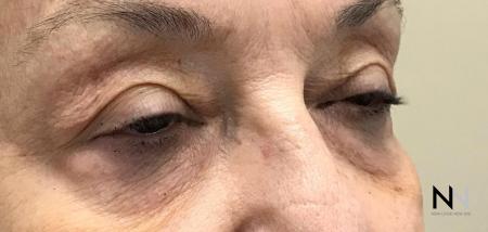 Fractional Resurfacing: Patient 7 - Before and After Image 2