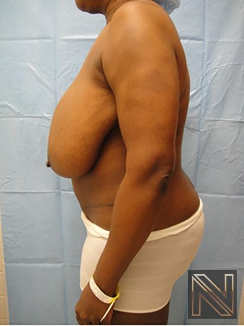 Breast Reduction: Patient 4 - Before 4