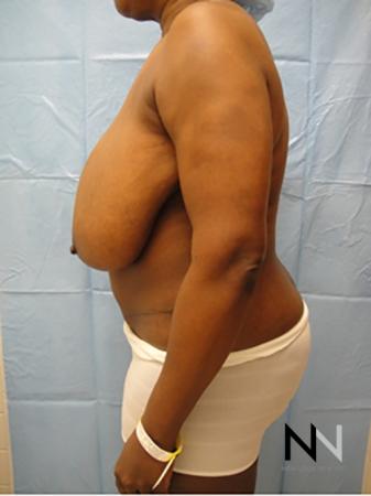 Breast Reduction: Patient 4 - Before Image 4