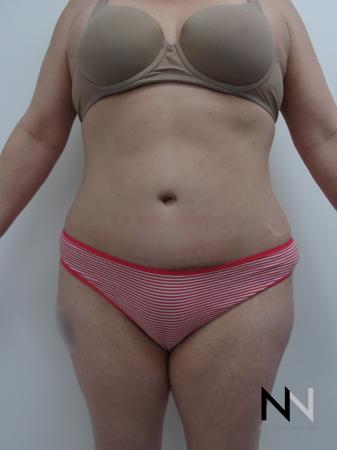 Abdominoplasty: Patient 21 - After Image 1
