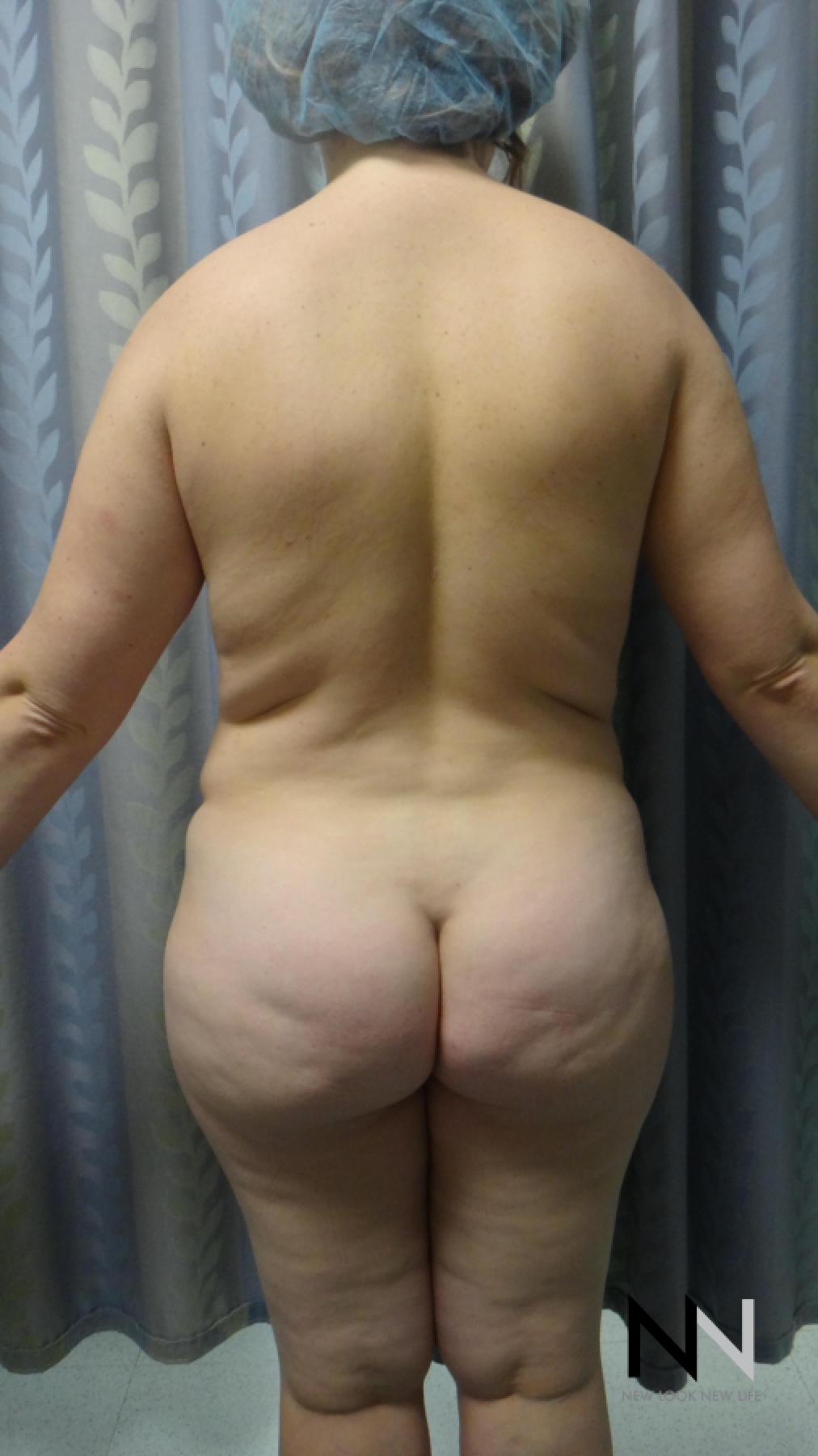 Abdominoplasty: Patient 24 - Before and After 4