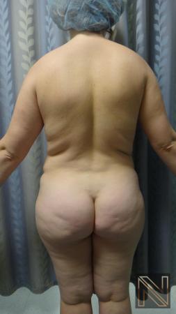 Abdominoplasty: Patient 24 - Before and After 4