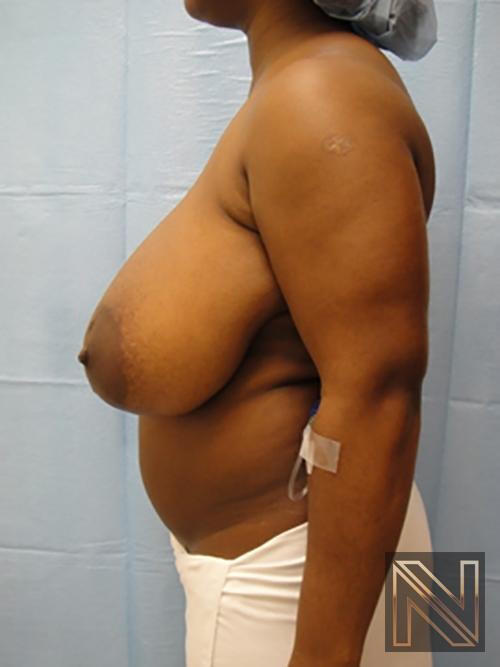 Breast Reduction: Patient 3 - Before 4
