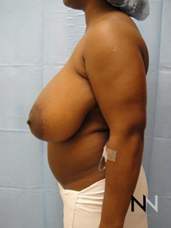 Breast Reduction: Patient 3 - Before Image 4
