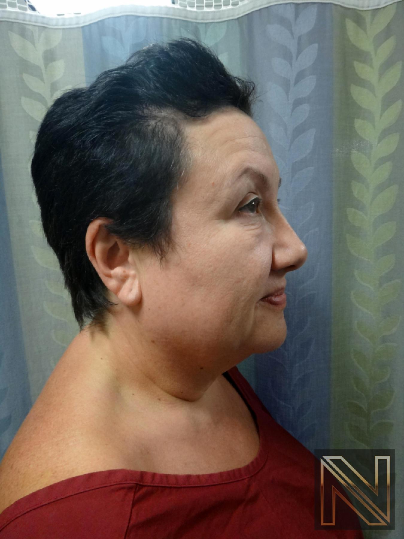 Facelift/Mini Facelift: Patient 6 - Before and After 2