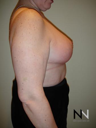Breast Reduction: Patient 8 - After Image 5