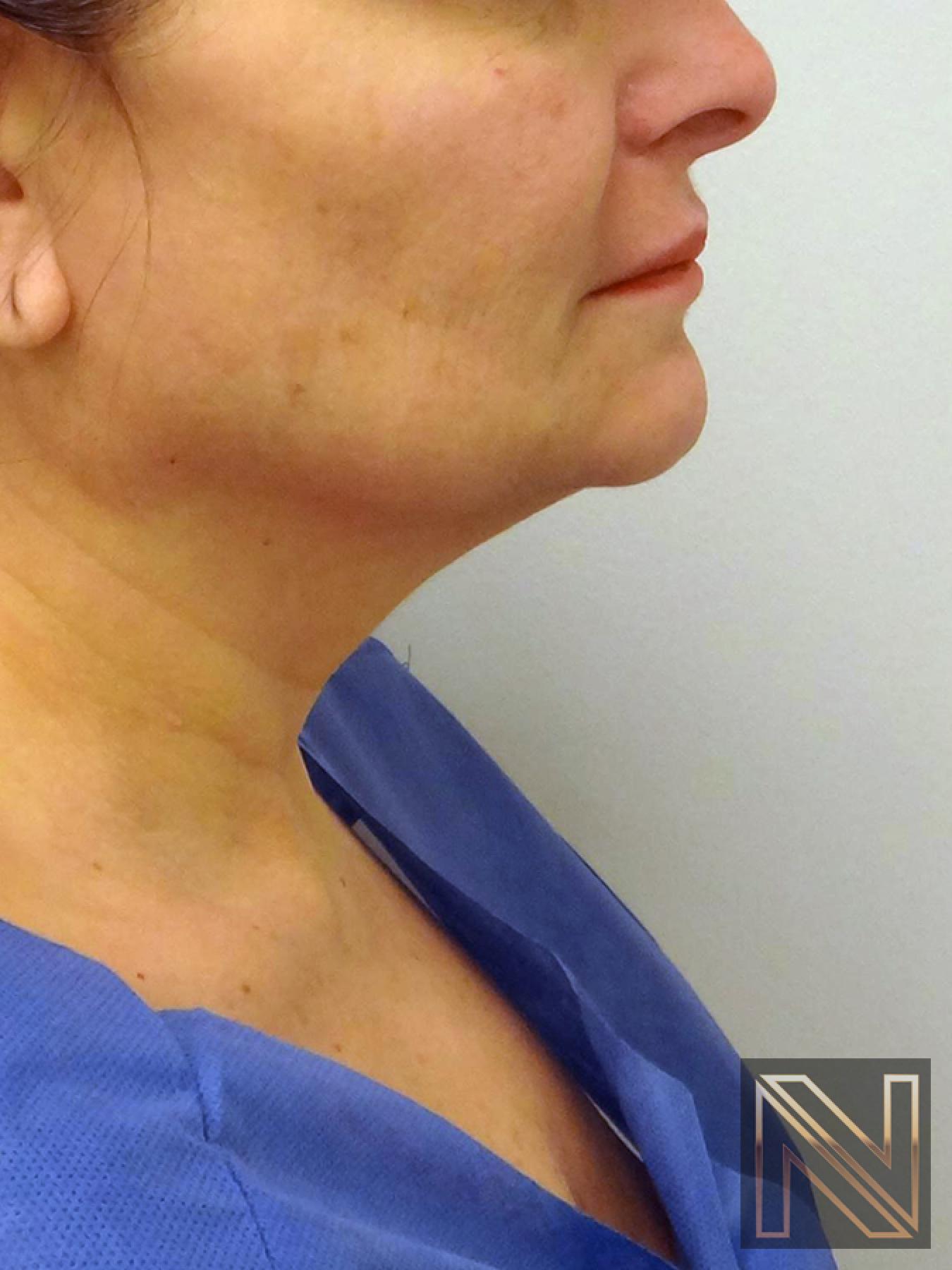 Facelift/Mini Facelift: Patient 8 - Before and After 2