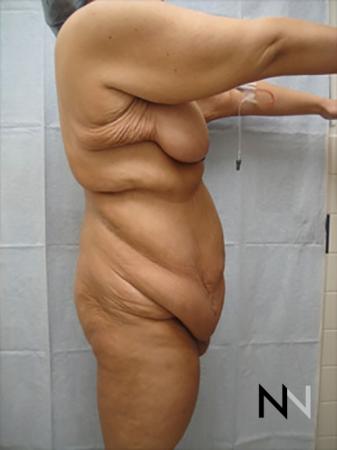 Abdominoplasty: Patient 17 - Before and After 3