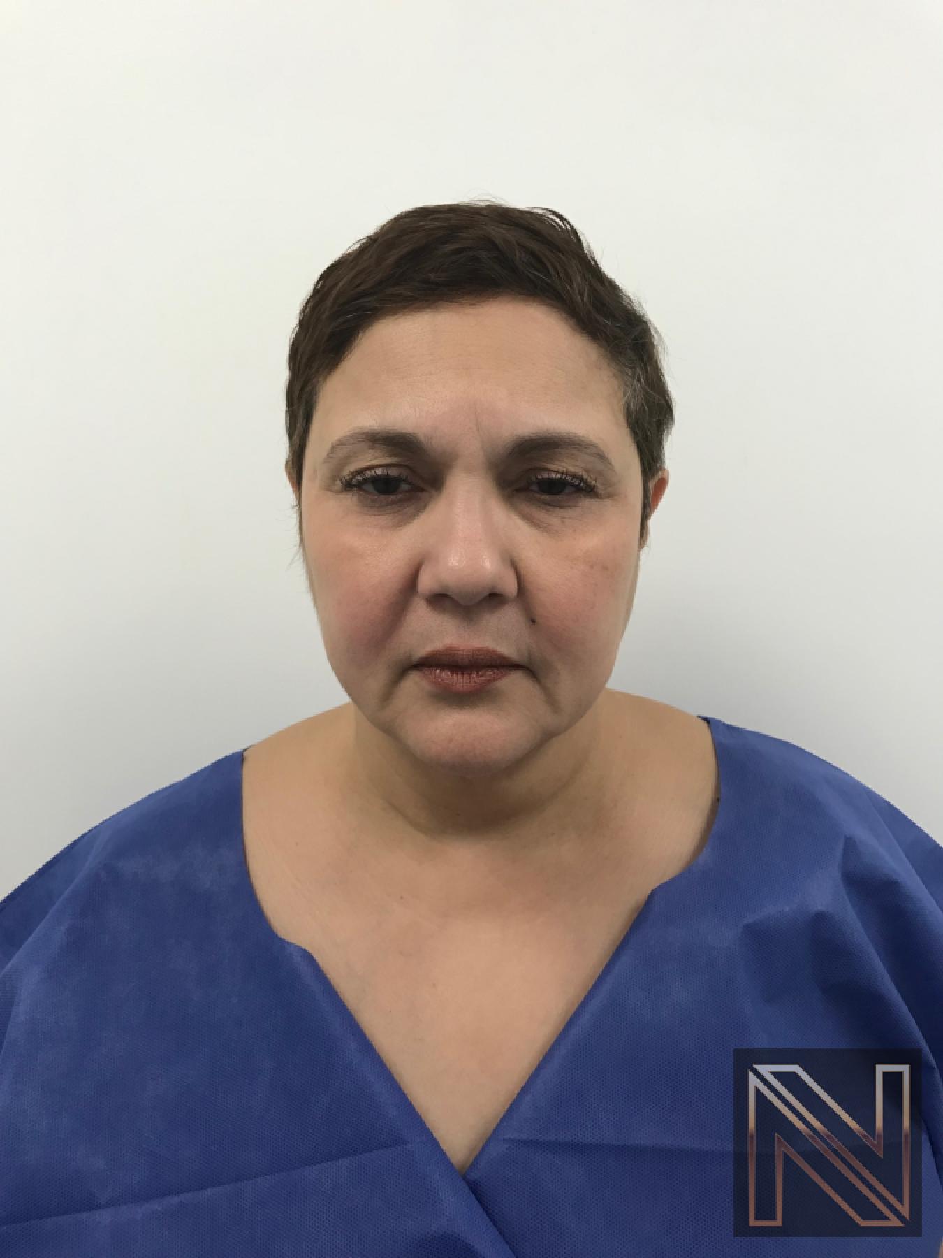 Facelift/Mini Facelift: Patient 1 - Before and After 5