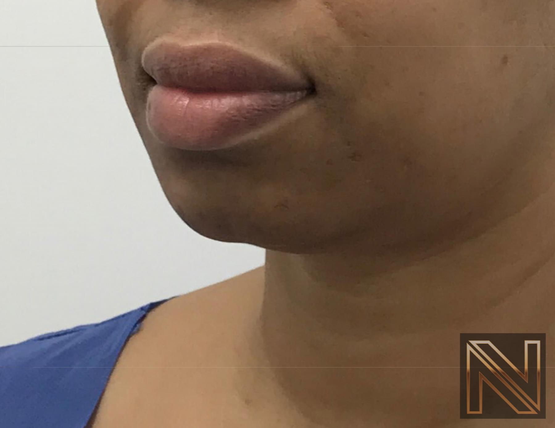 Chin Augmentation: Patient 3 - Before 2