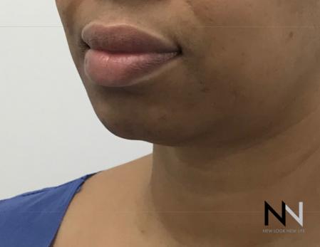 Chin Augmentation: Patient 3 - Before Image 2