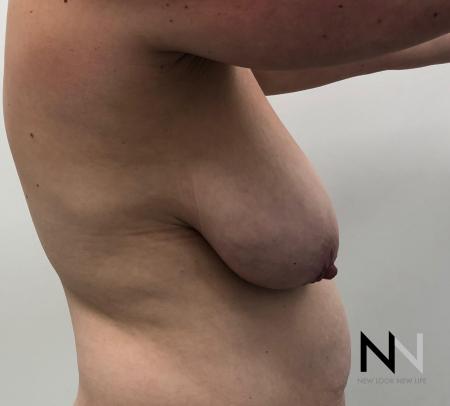 Breast Lift: Patient 16 - Before and After Image 3