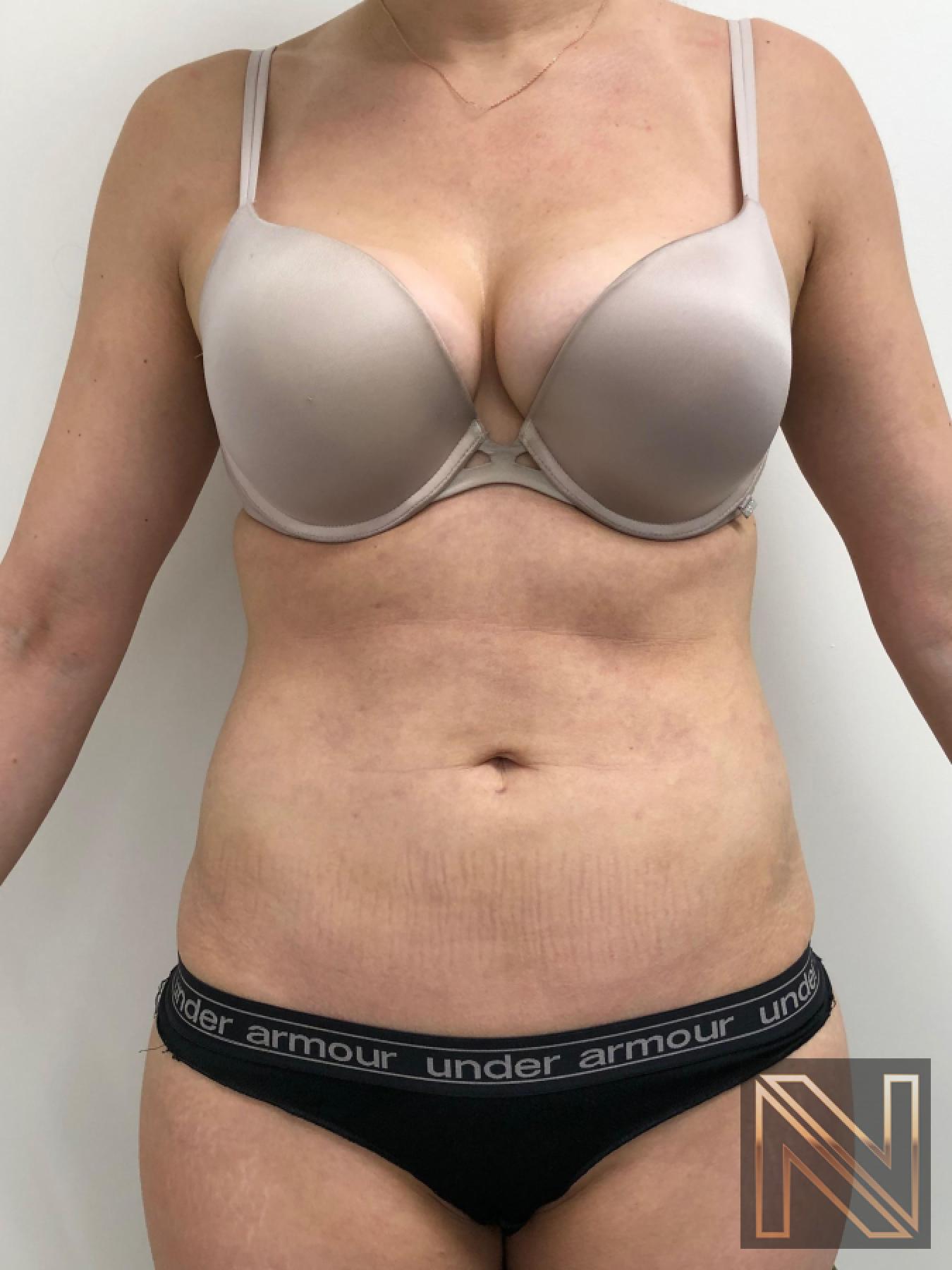 Liposuction: Patient 10 - After 1