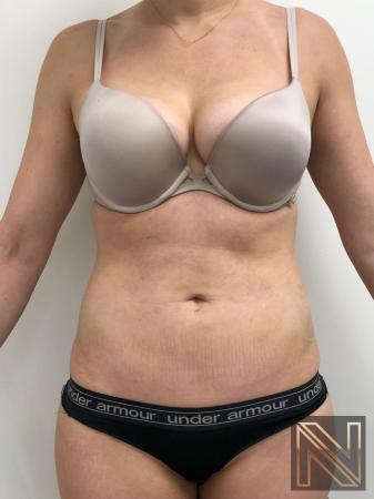 Liposuction: Patient 10 - After  