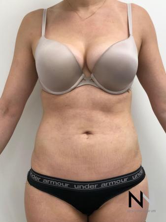 Liposuction: Patient 10 - After Image 1