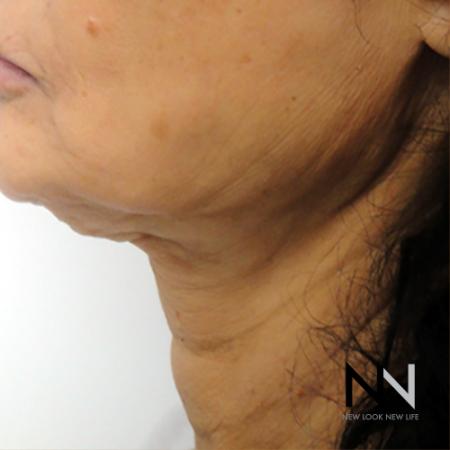 SkinTyte II™: Patient 2 - Before and After Image 2