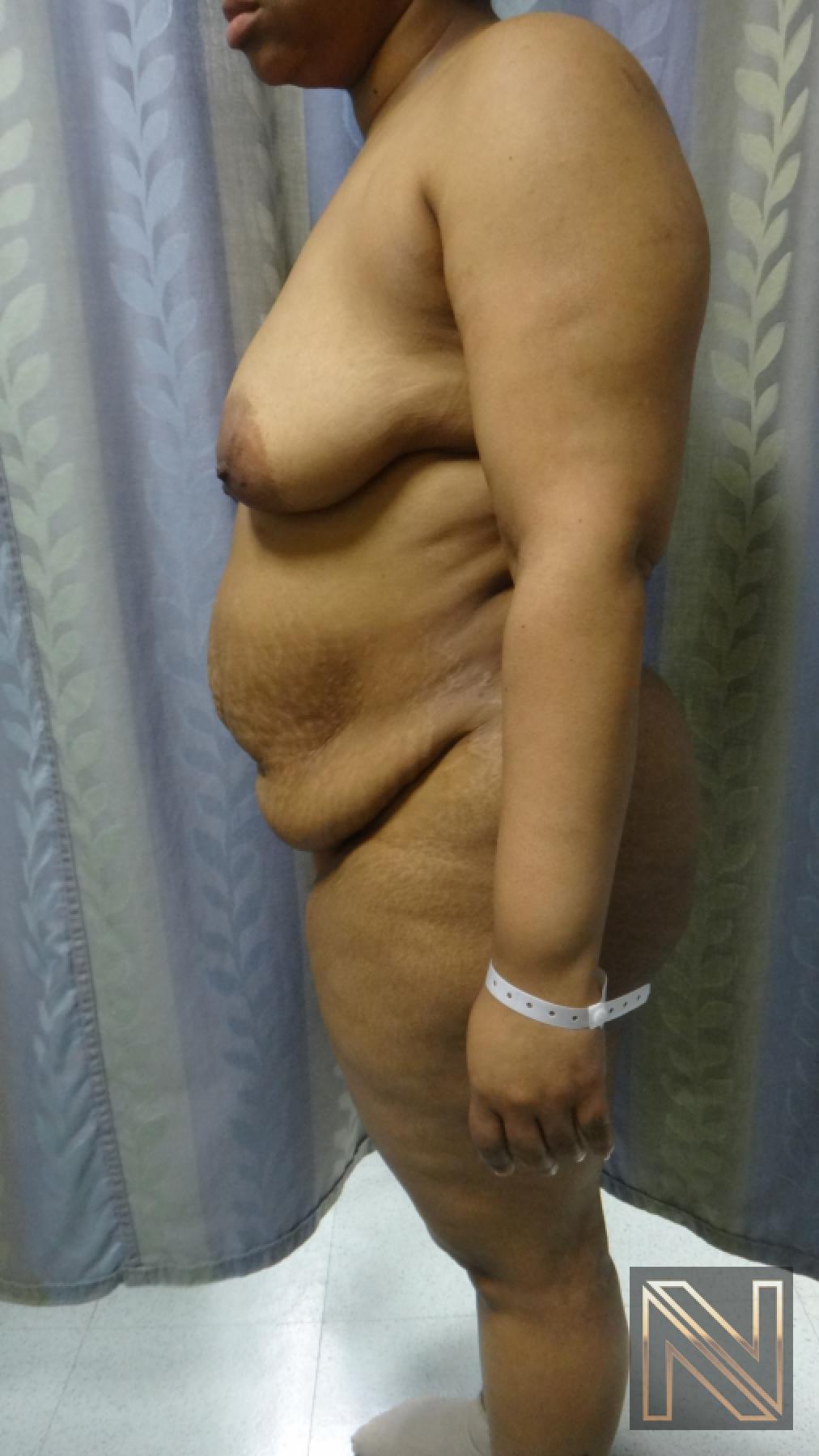 Abdominoplasty: Patient 23 - Before and After 2