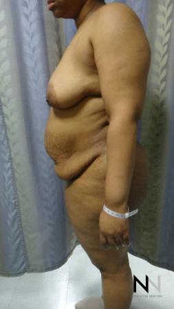 Abdominoplasty: Patient 23 - Before and After 2