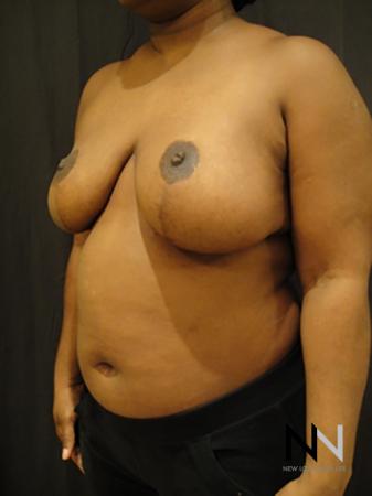 Breast Reduction: Patient 3 - After Image 2