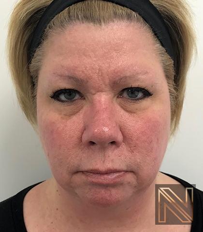Fractional Resurfacing: Patient 2 - Before and After 5