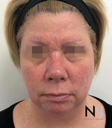 Fractional Resurfacing: Patient 2 - Before and After Image 5