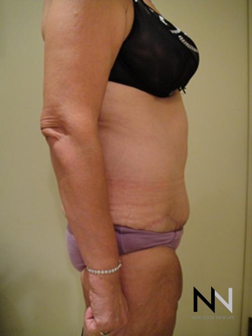 Abdominoplasty: Patient 3 - After 3