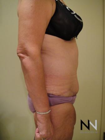 Abdominoplasty: Patient 3 - After Image 3