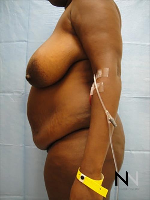 Abdominoplasty: Patient 9 - Before 2