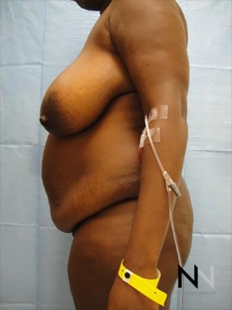 Abdominoplasty: Patient 9 - Before Image 2