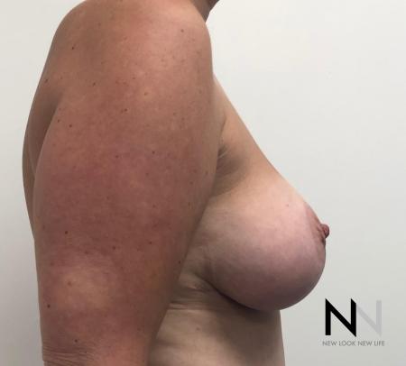 Breast Lift: Patient 16 - After Image 3