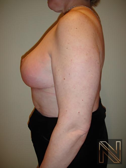 Breast Reduction: Patient 8 - After 4