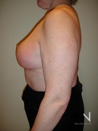 Breast Reduction: Patient 8 - After Image 4