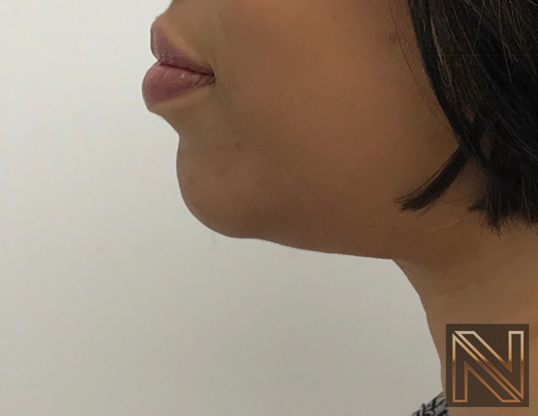 Chin Augmentation: Patient 3 - After 5