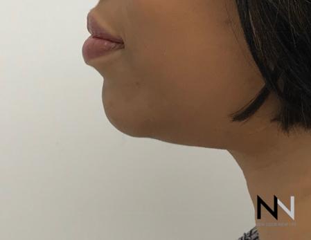 Chin Augmentation: Patient 3 - After Image 5