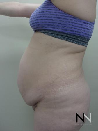 Abdominoplasty: Patient 21 - Before and After Image 3