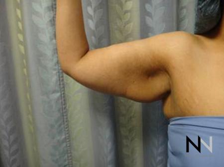 Brachioplasty: Patient 3 - Before and After Image 2