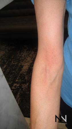 SkinTyte II™: Patient 1 - After Image 1