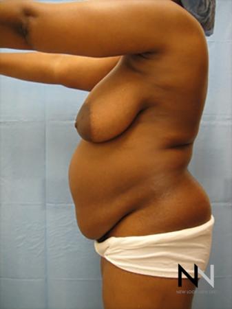 Abdominoplasty: Patient 10 - Before 2