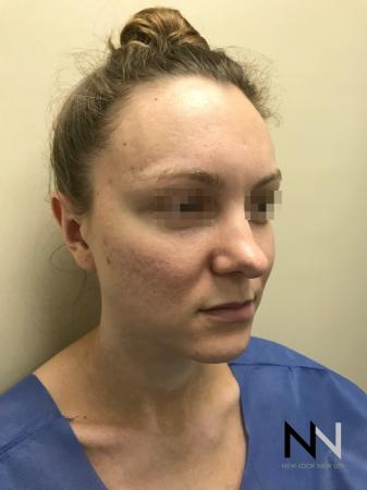 Fractional Resurfacing: Patient 4 - Before and After Image 4