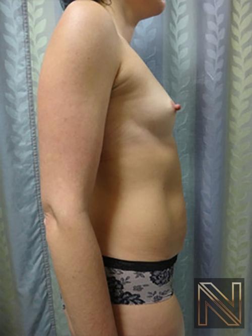 Breast Augmentation: Patient 9 - Before and After 5