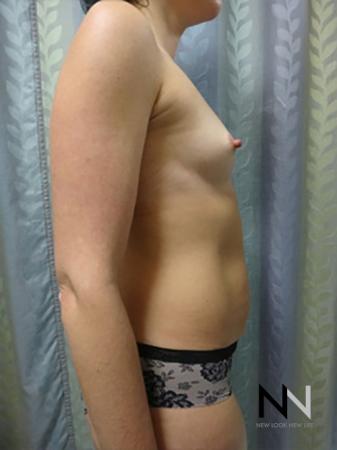 Breast Augmentation: Patient 9 - Before and After Image 5