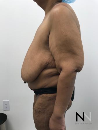 Breast Reduction: Patient 2 - Before and After Image 3