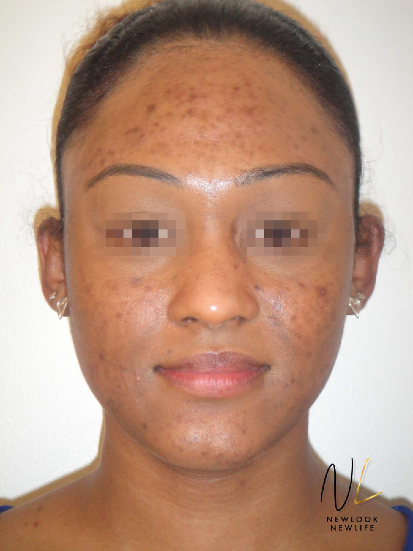 Laser Skin Resurfacing - Face: Patient 4 - Before 1