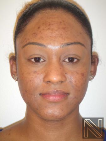Laser Skin Resurfacing - Face: Patient 4 - Before 
