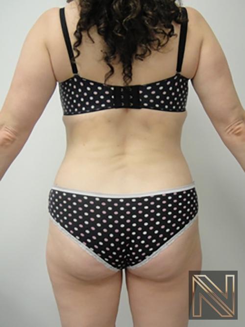 Liposuction: Patient 5 - After 4