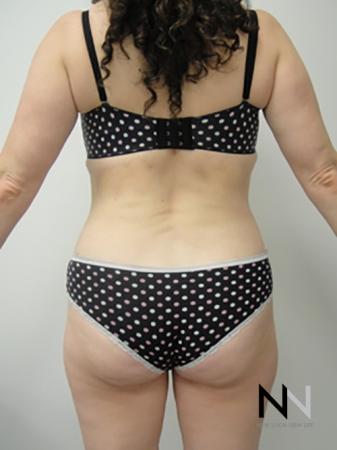 Liposuction: Patient 5 - After Image 4