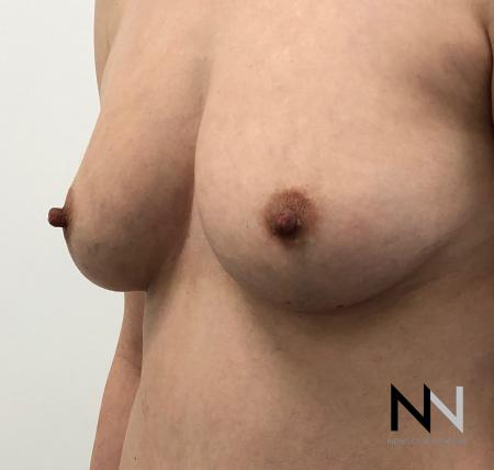 Fat Transfer - Body: Patient 2 - Before Image 2
