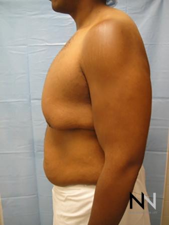 Gynecomastia: Patient 1 - Before Image 4